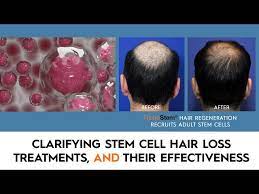 stem cell hair restoration