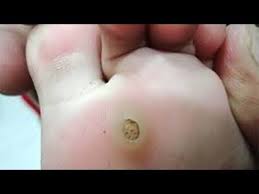 Os cravos são especialmente comuns na zona t do quando cutucamos a pele, corremos germes e bactérias presentes nos dedos e, dessa forma. Pin Em Receitas Para Cuidar Do Corpo