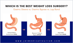 gastric sleeve vs byp vs lap band