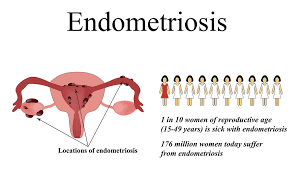 Learn more about the types, symptoms, causes, diagnosis, stages, treatment. Define Endometriosis Endo Meaning Australia Endometriosis Advice Online