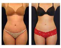 Image result for body shaping fat removal edmonton