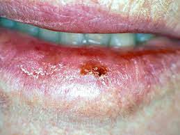 swollen lip on one side when to seek