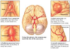 Pain in the abdomen or lower back extending into the groin and legs may be due to an abdominal aneurysm. Brain Aneurysm Gwinnett Medical Center