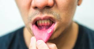 your guide to canker sores symptoms