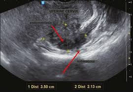 Infertility is a common complication of endometriosis that may be avoidable with early treatment. Scielo Brasil Transvaginal Ultrasound In Deep Endometriosis Pictorial Essay Transvaginal Ultrasound In Deep Endometriosis Pictorial Essay