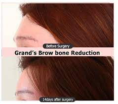 brow bone reduction