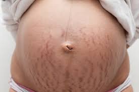 best tips on how to hide stretch marks