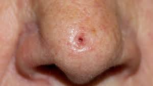 skin cancer on nose types symptoms