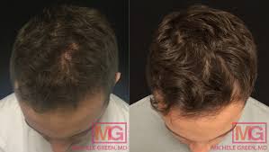 men s hair loss common questions about