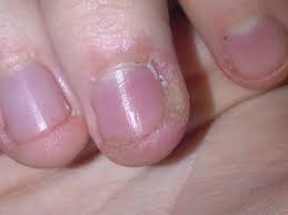 why is the skin around your nails