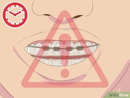 How to make brackets for fake braces | ehow.com. 3 Ways To Make Fake Braces Or A Fake Retainer Wikihow