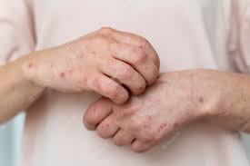 eczema what it is symptoms causes