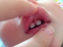 infant frenectomy a simple solution to