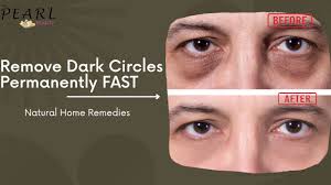 dark circles under the eyes deficiency