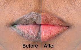 treatment to get rid of dark lips