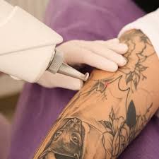 best laser tattoo removal in abad