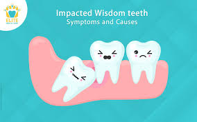 impacted wisdom teeth symptoms and