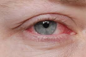 how long is pink eye conious