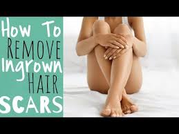 how to remove ingrown hair scars
