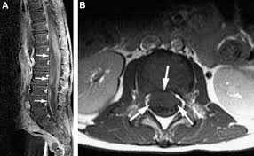 It carries a poor prognosis, not because of the subdural blood itself but because it is very often associated with an underlying parenchymal injury. Spinal Subdural Hematoma Following Posterior Fossa Surgery Sciencedirect