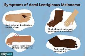 acral lentiginous melanoma symptoms