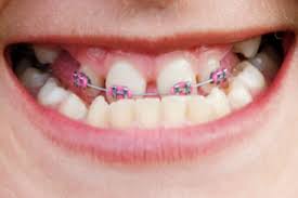 How much does invisalign cost? Why Orthodontics