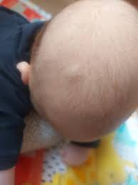 soft squashy lump on baby s head mumsnet