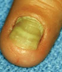 nails in systemic disease
