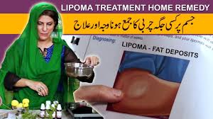 how to cure lipoma naturally