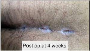 Pilonidal cysts can be caused by groups of hairs and skin debris that become trapped in the pores of the skin. Laser Pilonidotomy A New Approach In Management Of Complex Pilonidal Sinus Disease An Exploratory Study Sciencedirect