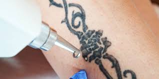 How many sessions will i need to remove my tattoo? How To Remove Your Tattoo Men S Health