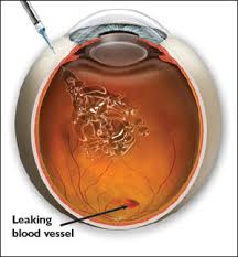 intravitreal injection rand eye insute