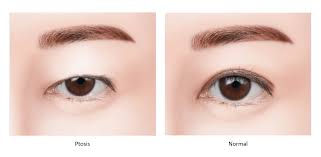 ptosis droopy eyelid surgery in