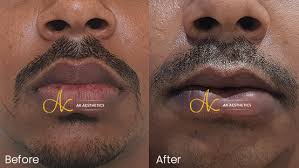 lip reduction surgery cost in jaipur