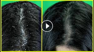 Most patients begin to notice dandruff during puberty. How To Remove Dandruff From Hair In One Wash
