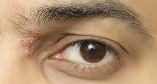 what are shingles in the eye
