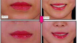 lip surgery cost in india get the