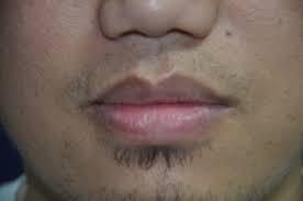 lip reduction cosmetic surgery