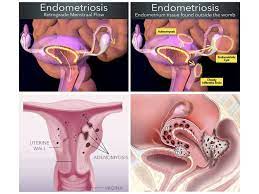 painful periods endometriosis