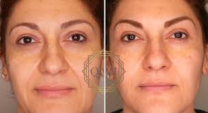 treatment for wrinkles and sagging jowls