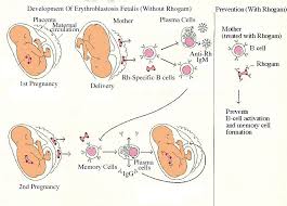 Rh Hemolytic Disease Of The Newborn Hematology