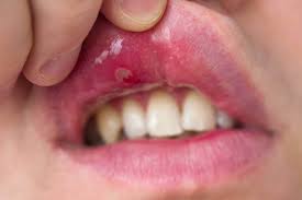 are my canker sores from grinding my teeth