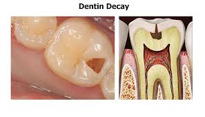 Image result for dental cavity images
