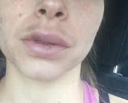 moustache bruise after juvederm is