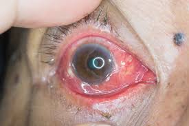chemosis eye irritation causes