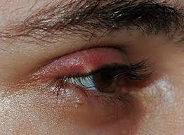 swollen eyelid causes treatment and