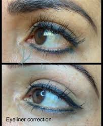 permanent makeup correction and removal