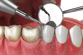 4 steps involved in periodonis therapy