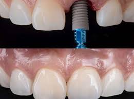 single tooth implant delhi india