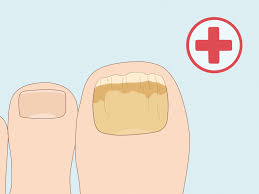 how to cure nail fungus home remes